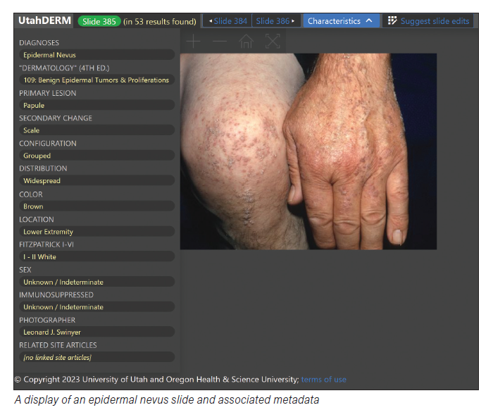 A display of an epidermal nevus slide and associated metadata